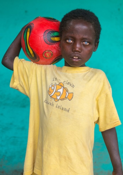 Az etiópiai koldus fiú genetikai hiba miatt csillaggá vált