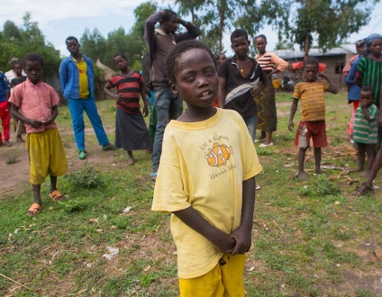 Az etiópiai koldus fiú genetikai hiba miatt csillaggá vált