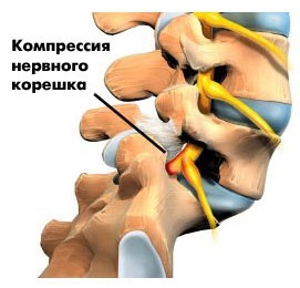 Operații cu deplasarea vertebrelor, centrul patologiei coloanei vertebrale a cormoranului