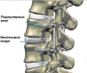 Operații cu deplasarea vertebrelor, centrul patologiei coloanei vertebrale a cormoranului