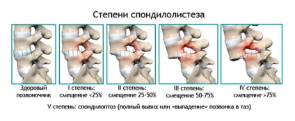 Operații cu deplasarea vertebrelor, centrul patologiei coloanei vertebrale a cormoranului