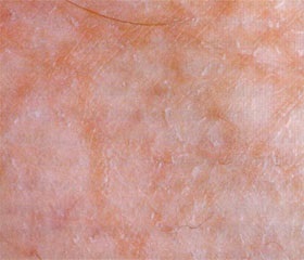 Principalele tipuri de piele a feței