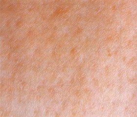 Principalele tipuri de piele a feței