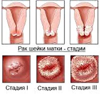 Carcinomul celulelor scuamoase ale colului uterin - cauze, simptome, diagnostic și tratament