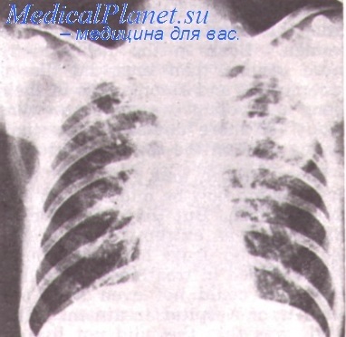 Indicatii pentru rezectia pulmonara pentru tuberculoame