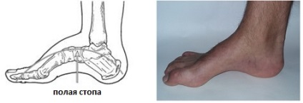Üreges láb, fotó előtt és után, műtét, felülvizsgálat, kezelés, rehabilitáció és helyreállítás
