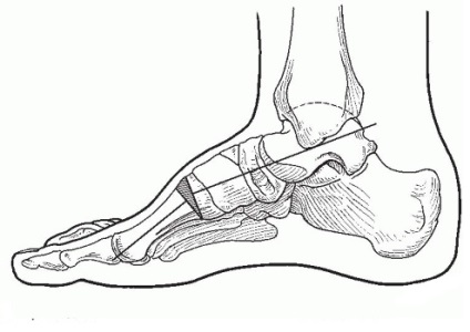 Picior coborât, fotografie înainte și după, chirurgie, recenzii, tratament, reabilitare și recuperare