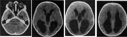 Malformațiile creierului - tomografia computerizată a creierului