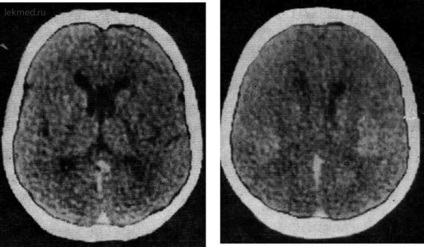 Malformațiile creierului - tomografia computerizată a creierului