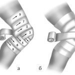 Bandaj pe articulația genunchiului - tipuri și metode de aplicare