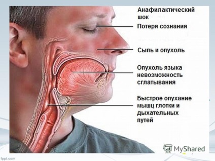 Anaphylaxiás sokk bemutatása (bemutatás) Előadás anafilaxiás sokkról