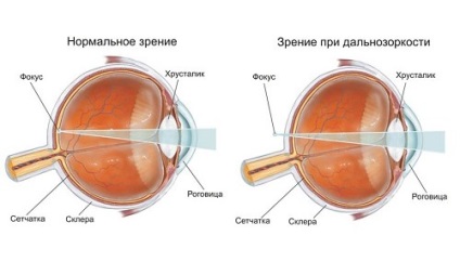 Cauze și simptome de hipermetropie