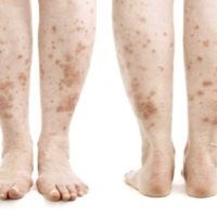 Petele pe picioare cu cauze varice și remedii
