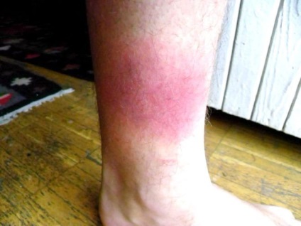 Petele pe picioare cu cauze varice și remedii
