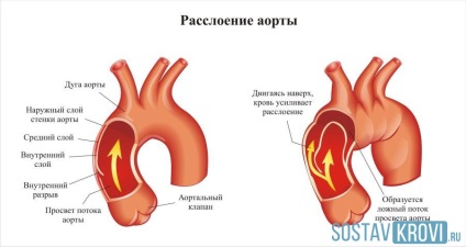 Stratificare a aortei inimii cavității abdominale, cauze, simptome și tratament