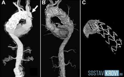 Stratificare a aortei inimii cavității abdominale, cauze, simptome și tratament