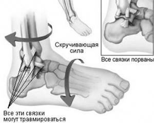Extinderea ligamentelor articulației gleznei așa cum este tratată