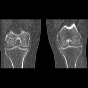 Diagnosticul cu raze X pentru gonartroză, a doua opinie