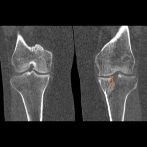 Diagnosticul cu raze X pentru gonartroză, a doua opinie