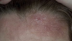 Dermatită seboreică a simptomelor și tratamentului scalpului