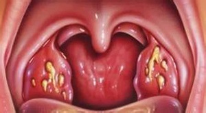 Simptome de durere în gât la un adult fără semne de temperatură, tratament, fotografie