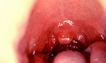 Simptome de durere în gât la un adult fără semne de temperatură, tratament, fotografie