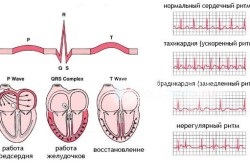 Simptomele aritmiei cardiace la bărbați