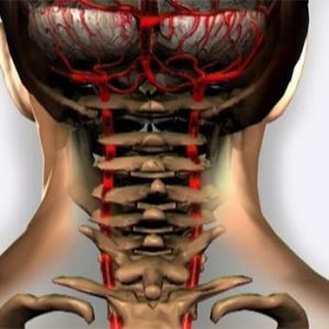 Simptomele și tratamentul hipoplaziei arteriale vertebrale