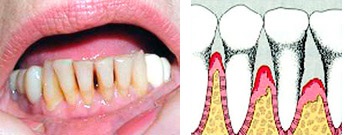 Simptome și metode de tratament al bolii parodontale, cauze și prevenire
