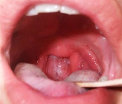 Mucus agregare în gât de cauze principale, gât