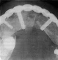 Sisteme de titan de plăci reconstructive cu șuruburi goale