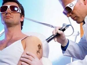 Îndepărtarea tatuajului, tatuajului, laserului, cum se întâmplă, câte proceduri aveți nevoie, prețul, contraindicațiile,