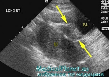 Examinarea ultrasonică a pelvisului mic