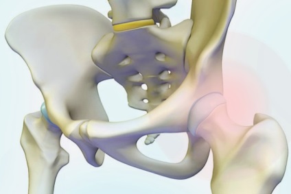 A csípőízületi tünetek és a kezelés vertikális fonákja