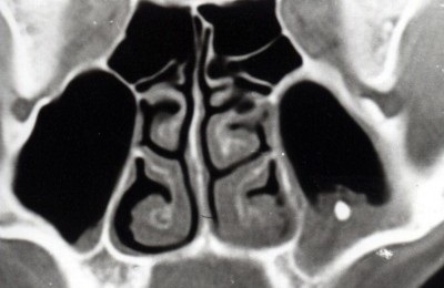 A maxilláris sinus idegen testben mit kell tenni, és hogyan kell eltávolítani