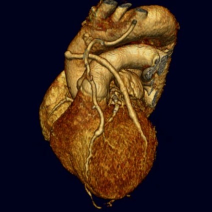Angiografia coronariană