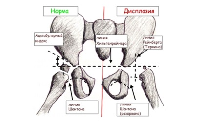 Displazia congenitală a articulației șoldului