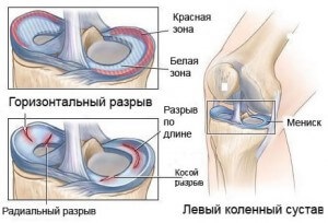 Arderea în articulația genunchiului - care ar putea fi cauzele