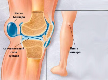 Arderea în articulația genunchiului - care ar putea fi cauzele