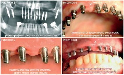 Implanturi dentare