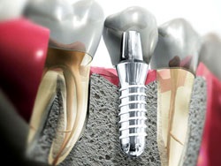 Implanturile dentare sunt bune sau rele