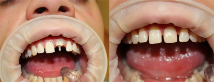 Dungi dinti, instalare si inlocuire pe dinte, preturi, fotografii, ce este un pin din fibra de sticla, care