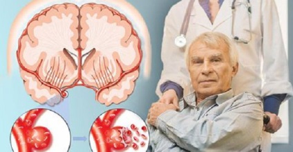 8 Semnale pe care corpul le dă înainte de un accident vascular cerebral! Amintiți-vă și fiți vigilenți!