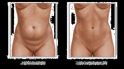 Abdominoplastia, clinica medicala