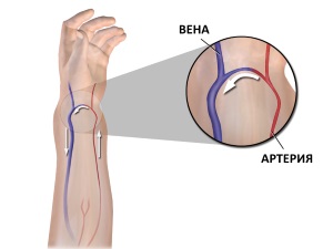 Arteriovenous fistula