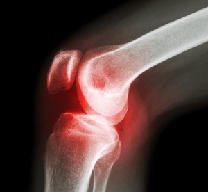 Artrita articulației genunchiului, cauzele, diagnosticul și tratamentul