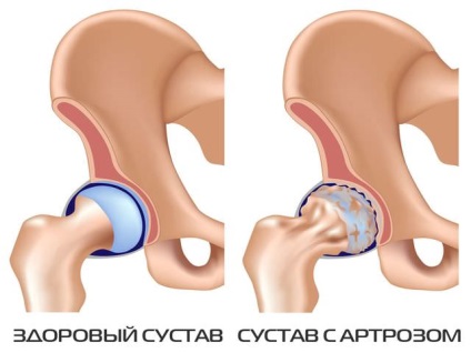 Osteoartrita simptomelor articulare de șold și tratamentul video