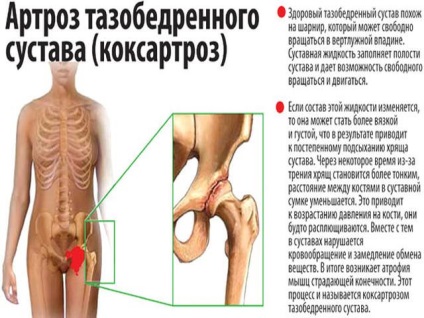 Osteoartrita simptomelor articulațiilor șoldului și tratamentul video