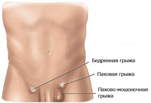 Herniile femurale la bărbați simptome, diagnostic, tratament