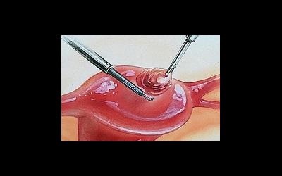 Sarcina dupa interventia chirurgicala la nivelul uterului, histeroscopie, cezariana,